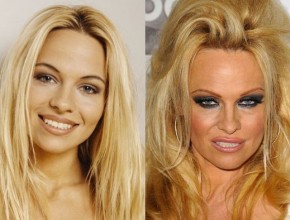 Pamela Anderson before and after plastic surgery 02