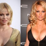 Pamela Anderson before and after plastic surgery 03