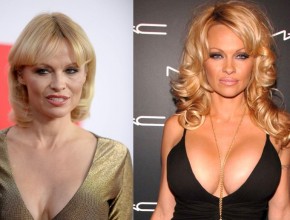 Pamela Anderson before and after plastic surgery 03