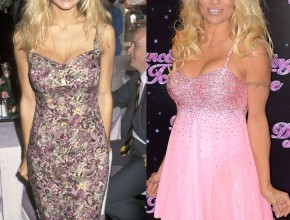 Pamela Anderson before and after plastic surgery