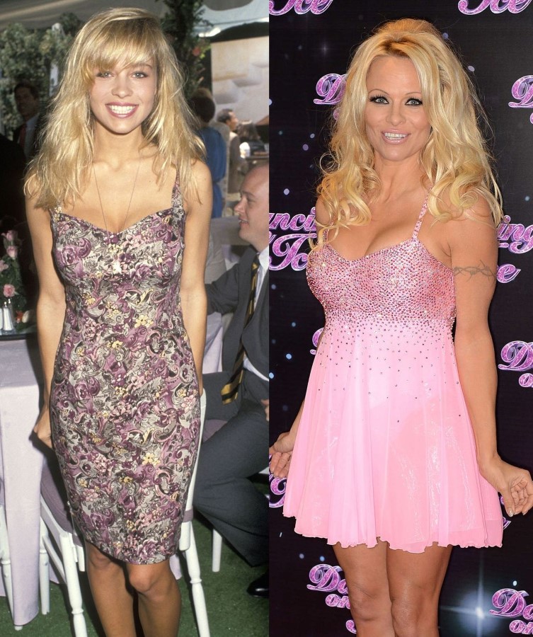 Pamela Anderson before and after plastic surgery