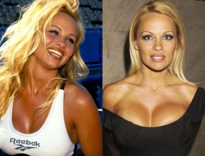 Pamela Anderson before and after plastic surgery