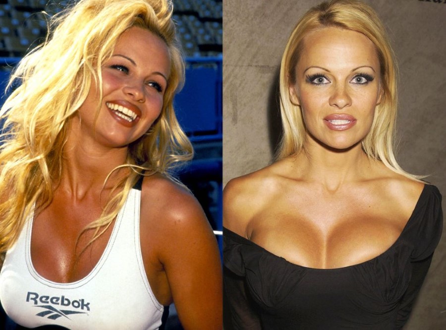 Pamela Anderson before and after plastic surgery