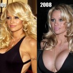 Pamela Anderson before and after plastic surgery