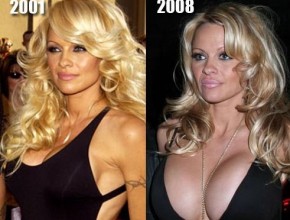 Pamela Anderson before and after plastic surgery