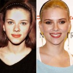 Scarlett Johansson before and after plastic surgery 02