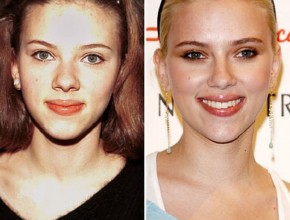 Scarlett Johansson before and after plastic surgery 02