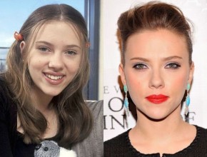 Scarlett Johansson before and after plastic surgery 03