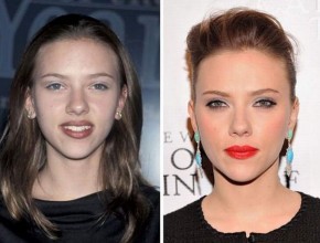 Scarlett Johansson plastic surgery