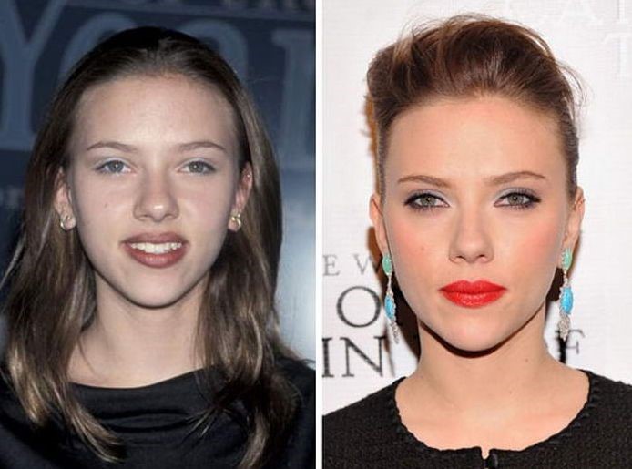 Scarlett Johansson before and after plastic surgery