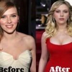 Scarlett Johansson before and after plastic surgery 05