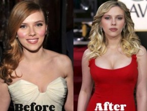 Scarlett Johansson before and after plastic surgery 05