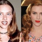 Scarlett Johansson before and after plastic surgery