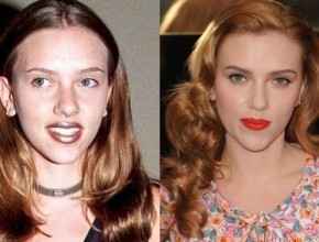 Scarlett Johansson before and after plastic surgery