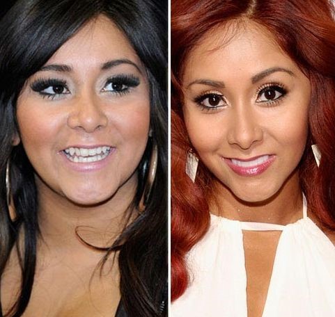 Snooki before and after plastic surgery, nose job and dental work