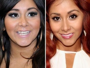 Snooki before and after plastic surgery, nose job and dental work