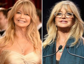 Goldie Hawn before and after plastic surgery 02