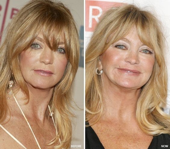 Goldie Hawn before and after plastic surgery