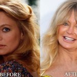 Goldie Hawn before and after plastic surgery 04