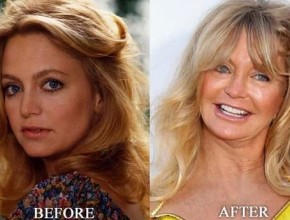 Goldie Hawn before and after plastic surgery 04