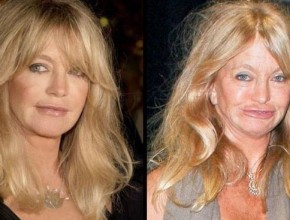 Goldie Hawn before and after plastic surgery 05
