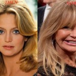 Goldie Hawn before and after plastic surgery