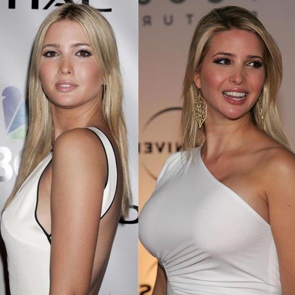Ivanka Trump before and after breast augmentation