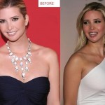 Ivanka Trump before and after breast augmentation 01