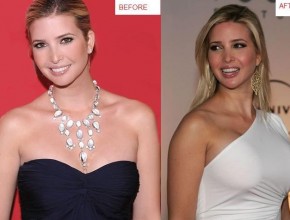 Ivanka Trump before and after breast augmentation 01