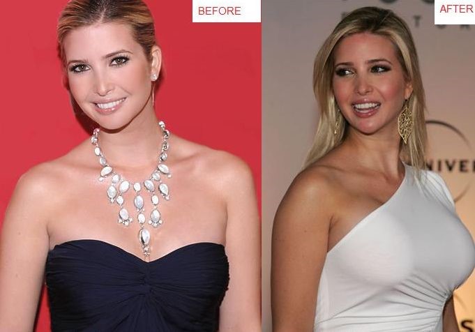 Ivanka Trump before and after breast augmentation 01.