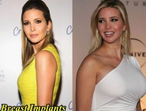 Ivanka Trump before and after breast implants