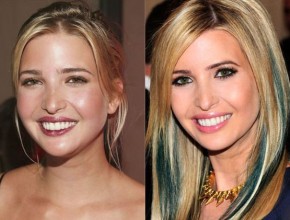 Ivanka Trump before and after plastic surgery 05