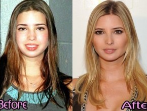 Ivanka Trump before and after plastic surgery 2