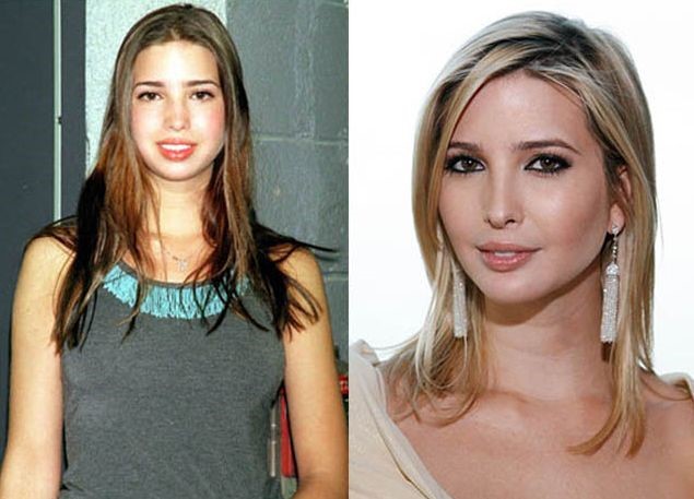 Ivanka Trump before and after plastic surgery