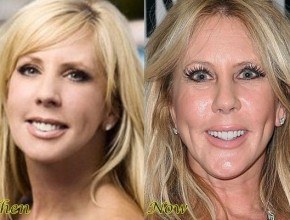 Vicki Gunvalson before and after botox injections