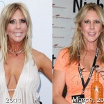 Vicki Gunvalson before and after plastic surgery