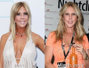 Vicki Gunvalson before and after plastic surgery