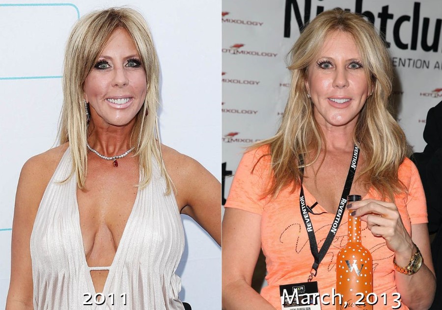 Vicki Gunvalson before and after plastic surgery