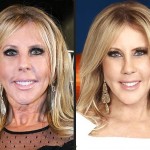 Vicki Gunvalson before and after plastic surgery 03