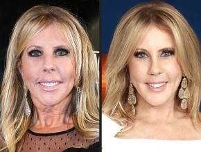 Vicki Gunvalson before and after plastic surgery 03