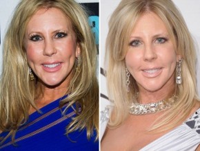 Vicki Gunvalson before and after plastic surgery 01