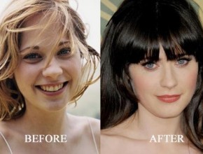 Zooey Deschanel before and after plastic surgery