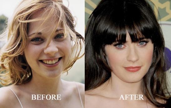Zooey Deschanel before and after plastic surgery