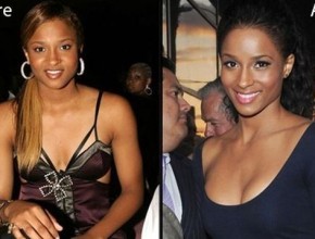 Ciara before and after breast augmentation