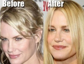 Daryl Hannah before and after plastic surgery 04