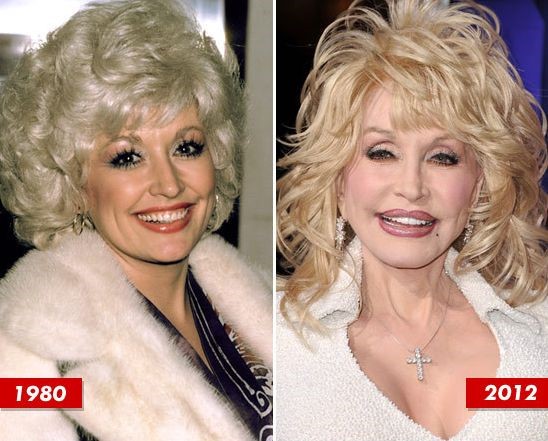 Dolly Parton before and after plastic surgery