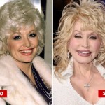 Dolly Parton before and after plastic surgery 01