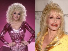 Dolly Parton before and after plastic surgery 02