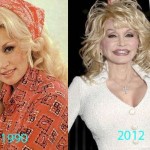 Dolly Parton before and after plastic surgery 03