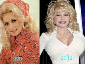 Dolly Parton before and after plastic surgery 03